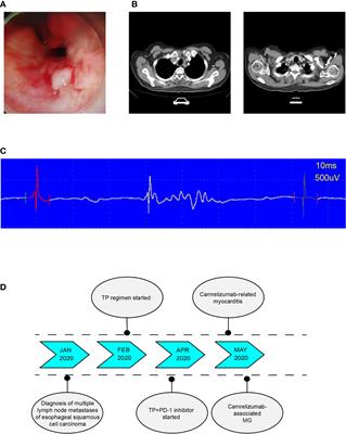 Camrelizumab-Related Myocarditis and Myositis With Myasthenia Gravis: A Case Report and Literature Review